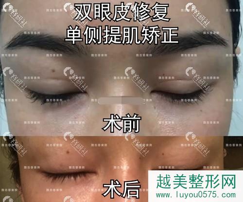 北京丽星翼美医疗美容魏志香双眼皮修复前后对比
