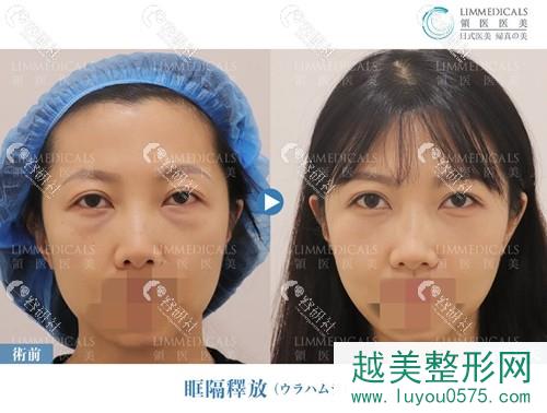 北京领医医疗美容门诊部双眼皮修复前后果对比