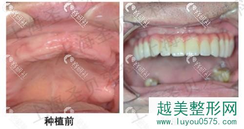 上海口腔医院种植牙案例