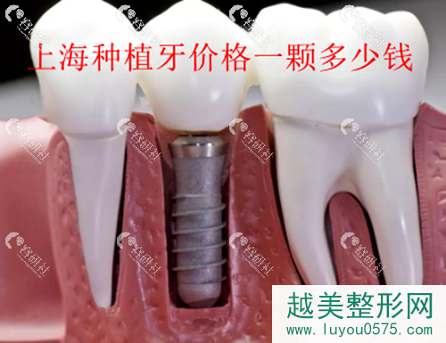 上海种植牙价格，种植牙一颗多少钱？
