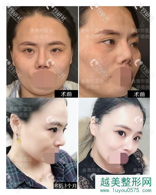 北京柏丽医疗美容门诊部李劲良鼻部手术前后果对比