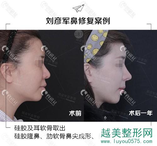 北京沃尔医疗美容诊所刘彦军鼻修复案例
