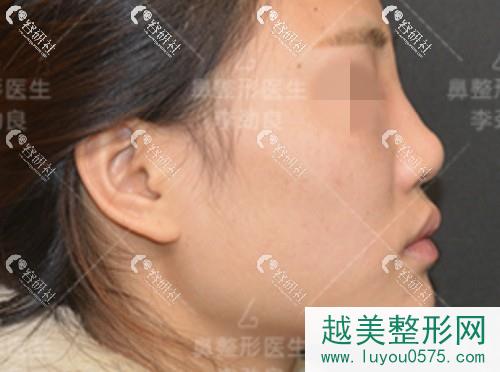 北京柏丽医疗美容李劲良鼻修复