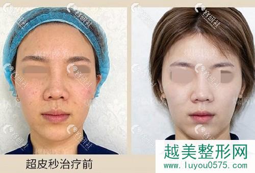 北京煤医医疗美容医院超激光美肤祛斑前后果对比照片