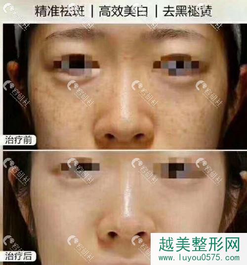 北京画美医疗美容医院超激光美肤祛斑前后果对比照片
