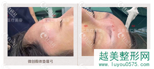 北京童仁欧素娇医生假体垫眉弓前后果对比照片