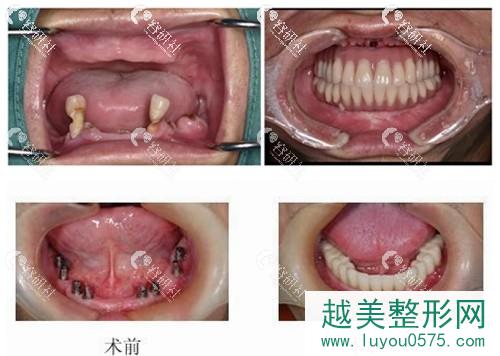 上海中博口腔种植牙案例
