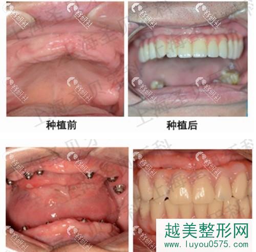 上海圣贝口腔种植牙案例对比图