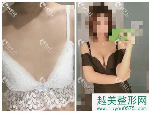 北京八大处整形外科穆大力假体隆胸案例