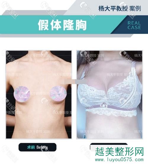 北京联合丽格医疗美容医院杨大平假体隆胸前后果对比