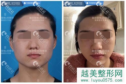 北京联合丽格何照华下颌角截骨前后果对比照片