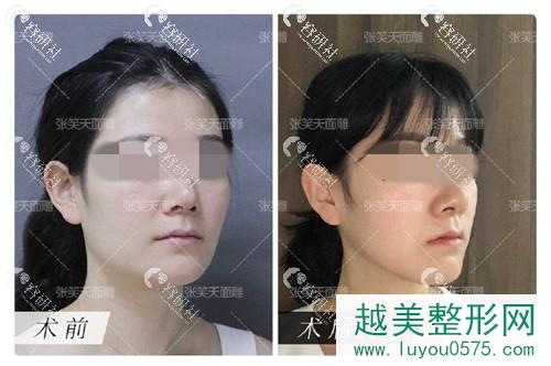 北京圣嘉新医疗美容医院张笑天下颌角磨骨前后果对比