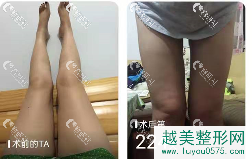 上海伊莱美大腿吸脂案例
