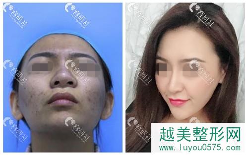 广州中家医隆鼻术前术后对比