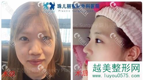 韩国珠儿丽医院鼻部手术案例对比图