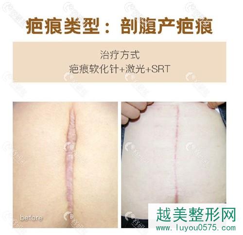 上海清沁医疗美容门诊部剖腹产疤痕修复前后对比照片