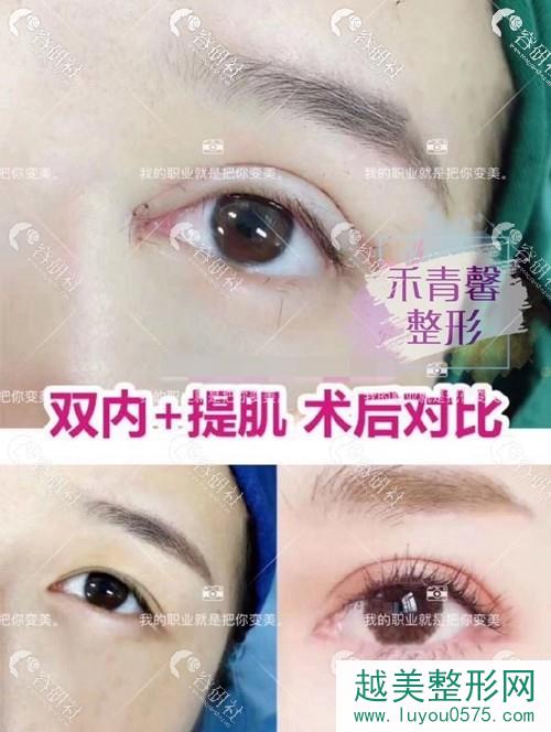 青岛禾青馨医疗美容双眼皮+提肌前后果对比