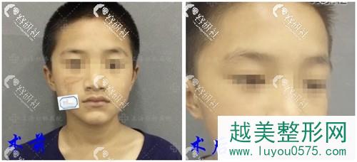 上海虹桥医院疤痕科做激光去疤痕案例对比图片