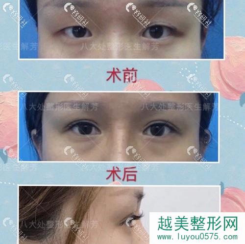 北京八大处眼解芳医生割双眼皮前后果对比