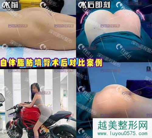 深圳鹏程整形医院自体脂肪丰臀前后果对比照片