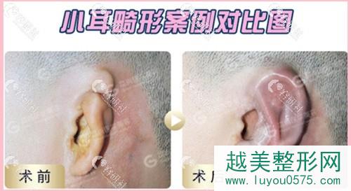 广州高尚医学美容小耳畸形修复案例