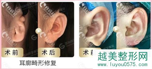 广州高尚医学美容耳廓/耳垂畸形修复案例