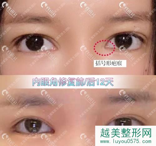 韩国珠儿丽双眼皮手术案例