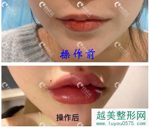上海玫瑰医院玻尿酸丰唇案例对比果图展示