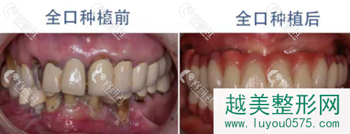 北京佳美口腔种植牙案例