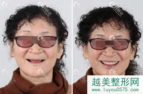 北京佳美口腔种植牙术前术后对比
