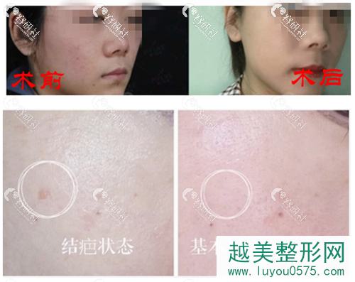 上海祛斑果好的美莱医院激光美肤激光祛斑案例术前术后果对比图