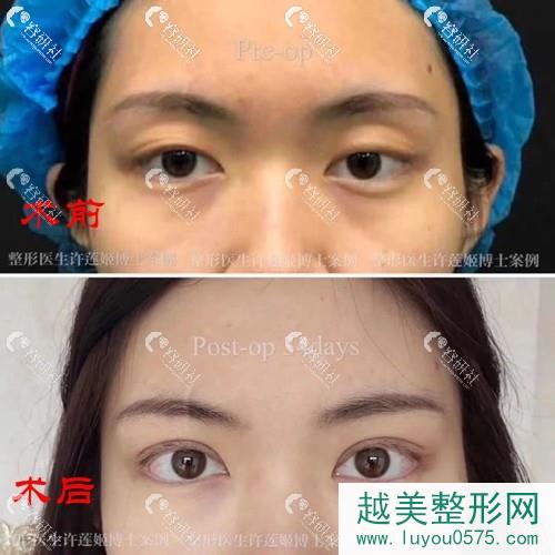 北京同仁医院许莲姬医生做的双眼皮失败修复案例对比图