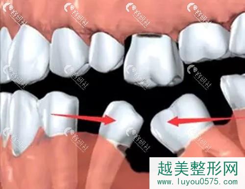 单颗牙齿缺失导致临牙倾斜