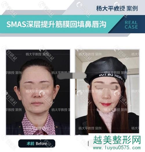 北京联合丽格杨大平SMAS深层提升筋膜回填鼻唇沟前后果对比