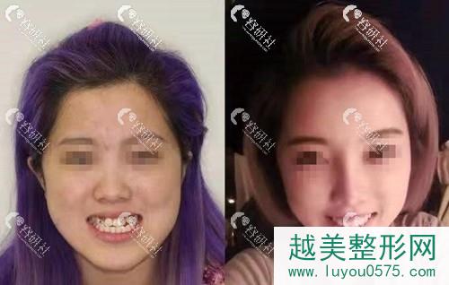 上海九院韦敏医生双颌正颌手术案例分享