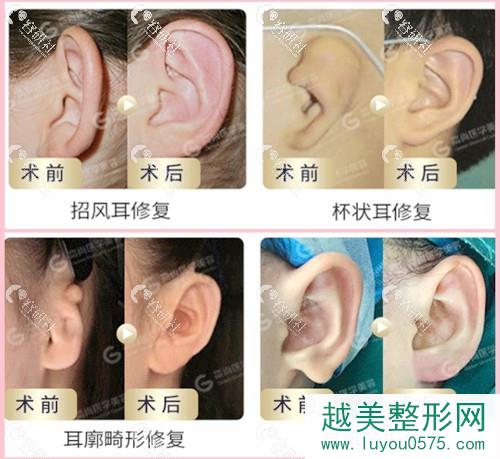 广州高尚医学美容中心余文林耳朵整形案例