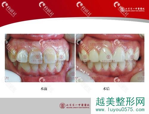 北京京一口腔医院牙齿矫正前后对比照片