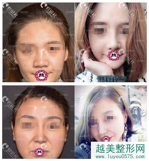 北京柏丽李劲良做鼻子案例分享