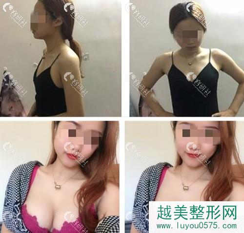 重庆新铜雀台假体隆胸术前术后果图