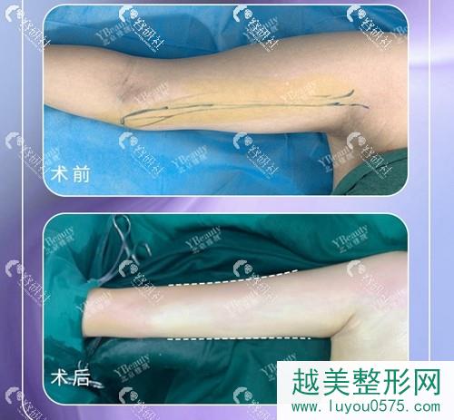 北京雅靓医疗美容国海军医生手臂吸脂前后对比照片