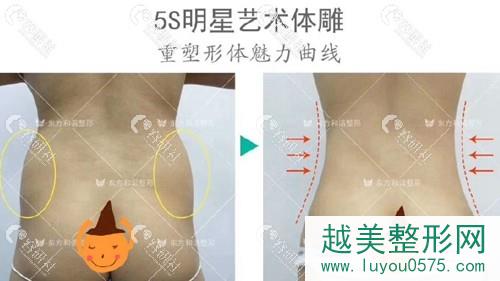 北京东方和谐医疗美容妈妈臀吸脂前后对比照片
