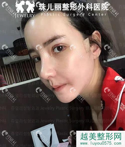 韩国珠儿丽眼鼻手术+颧骨缩小案例术后恢复照
