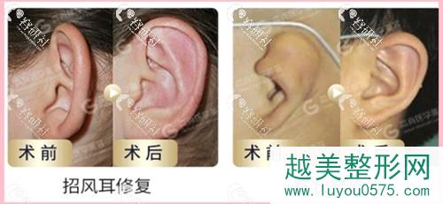 广州高尚医疗美容中心余文林耳部整形案例