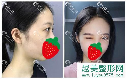 北京常冬青双眼皮修复前后对比