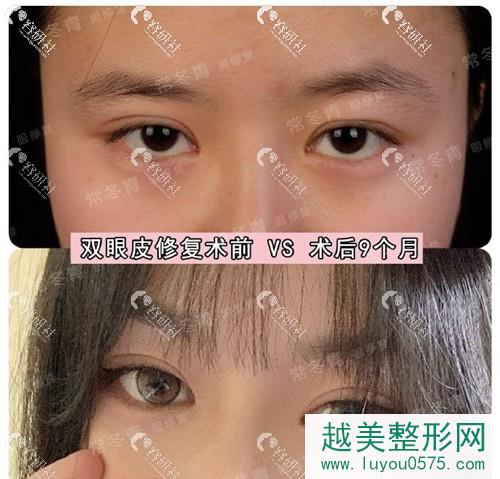 北京常冬青双眼皮修复前后对比