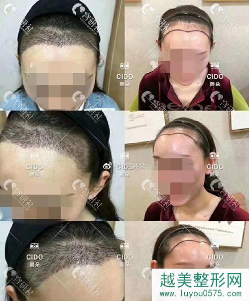 北京熙朵植发发际线种植前后对比照片