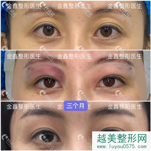 做双眼皮失败后，找深圳金鑫修复后三个月恢复的前后对比果图