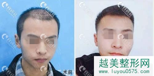 雍禾植发天津分院头顶加密种植恢复5个月前后对比照片