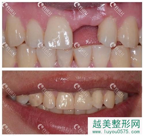 北京顺义博爱口腔单颗牙缺失种植案例