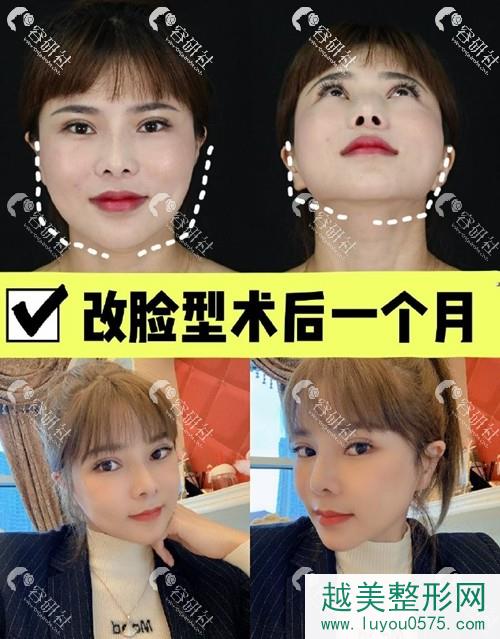 上海伊莱美李湘原医生改脸型术后1个月案例照